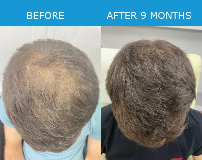 Before and after PRP hair loss treatment result 5 at London Hair Transplant Clinic