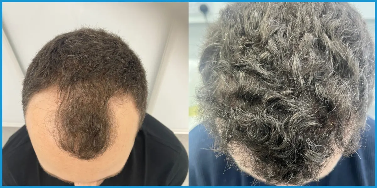 Before and after hairline restoration case study 1 at London Hair Transplant Clinic