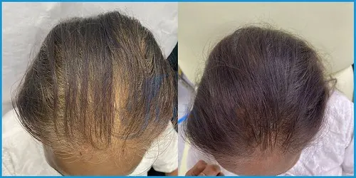 Before and after PRP and eyebrow restoration result 1 at London Hair Transplant Clinic