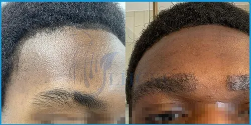 Before and after PRP and eyebrow restoration result 2 at London Hair Transplant Clinic