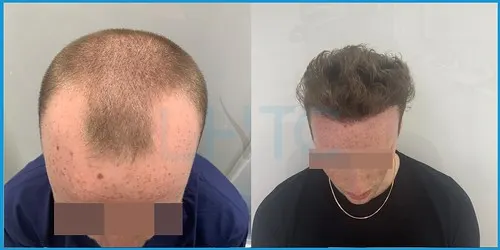 Post-treatment hair transplant recovery timeline photo 1 at London Hair Transplant Clinic