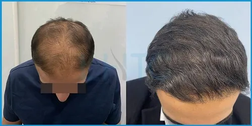 Post-treatment hair transplant recovery timeline photo 2 at London Hair Transplant Clinic