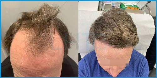 Post-treatment hair transplant recovery timeline photo 3 at London Hair Transplant Clinic