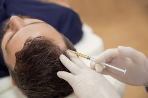 PRP Hair Loss Treatment London