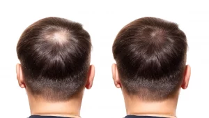 Crown vs Hairline Transplants